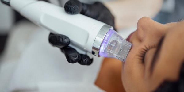 Microneedle RF lifting procedure